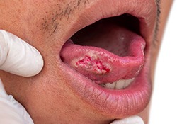 Oral cancer on the tongue