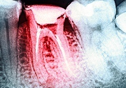 X-ray of root canal treated tooth