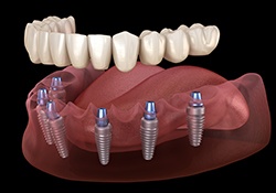 A 3D illustration of an implant denture being placed