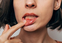 Woman with gum irritation