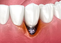 Handsome male dental patient in treatment chair